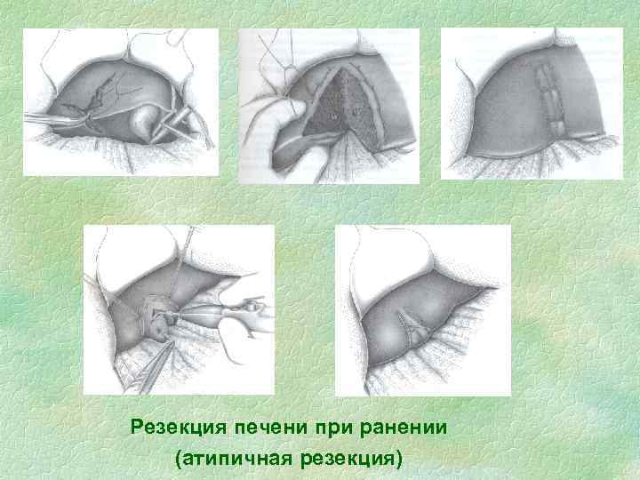 Резекция печени при ранении (атипичная резекция) 