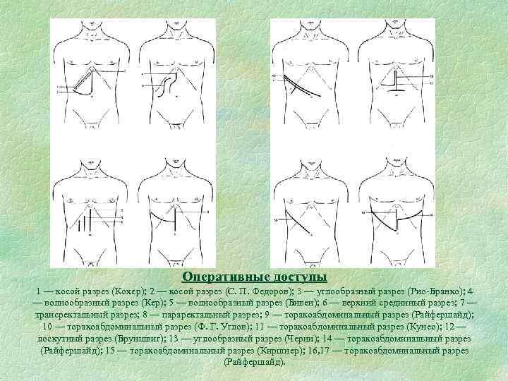 Оперативные доступы 1 — косой разрез (Кохер); 2 — косой разрез (С. П. Федоров);