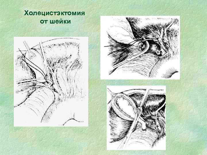 Холецистэктомия от шейки 