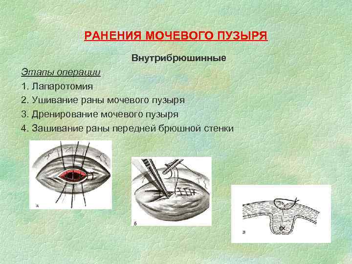 РАНЕНИЯ МОЧЕВОГО ПУЗЫРЯ Внутрибрюшинные Этапы операции 1. Лапаротомия 2. Ушивание раны мочевого пузыря 3.