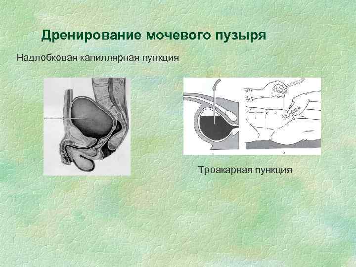 Дренирование мочевого пузыря Надлобковая капиллярная пункция Троакарная пункция 