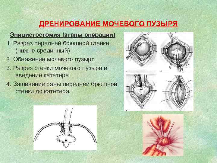 ДРЕНИРОВАНИЕ МОЧЕВОГО ПУЗЫРЯ Эпицистостомия (этапы операции) 1. Разрез передней брюшной стенки (нижне-срединный) 2. Обнажение