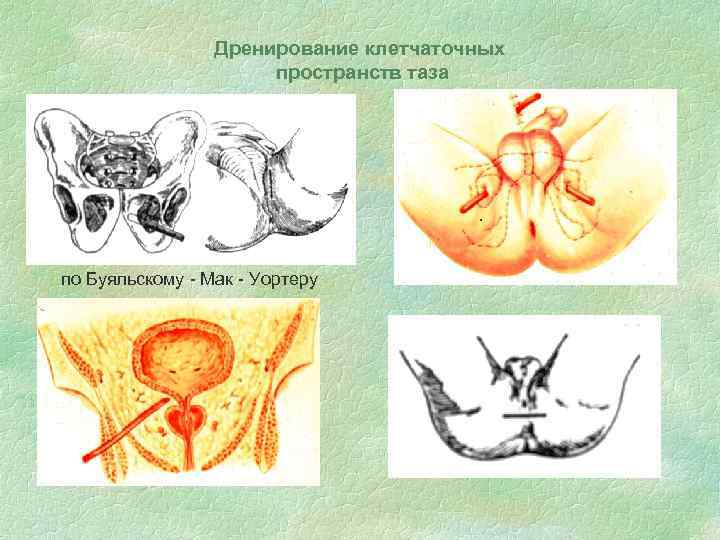 Дренирование клетчаточных пространств таза по Буяльскому - Мак - Уортеру 