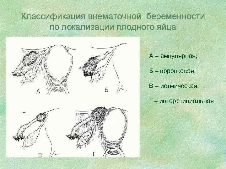 Классификация внематочной беременности по локализации плодного яйца А – ампулярная; Б – воронковая; В