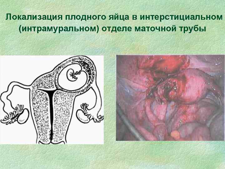 Локализация плодного яйца в интерстициальном (интрамуральном) отделе маточной трубы 