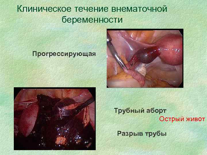 Клиническое течение внематочной беременности Прогрессирующая Трубный аборт Острый живот Разрыв трубы 