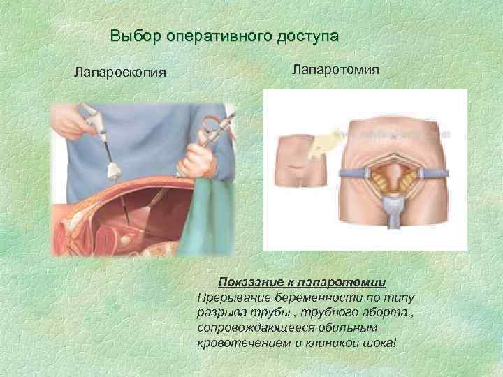 Выбор оперативного доступа Лапароскопия Лапаротомия Показание к лапаротомии Прерывание беременности по типу разрыва трубы