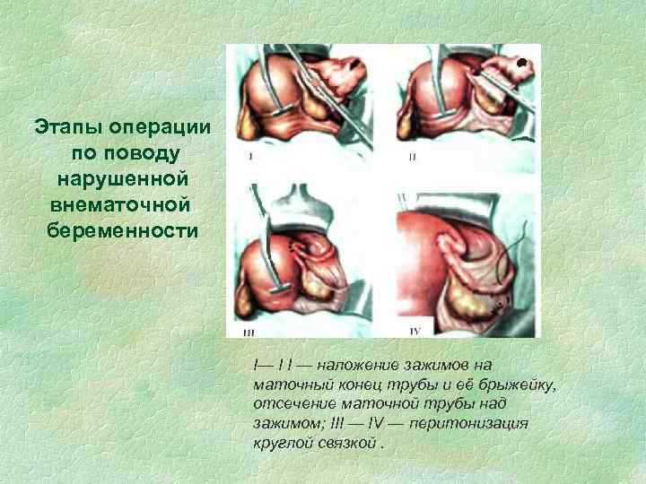 Этапы операции по поводу нарушенной внематочной беременности I— I I — наложение зажимов на