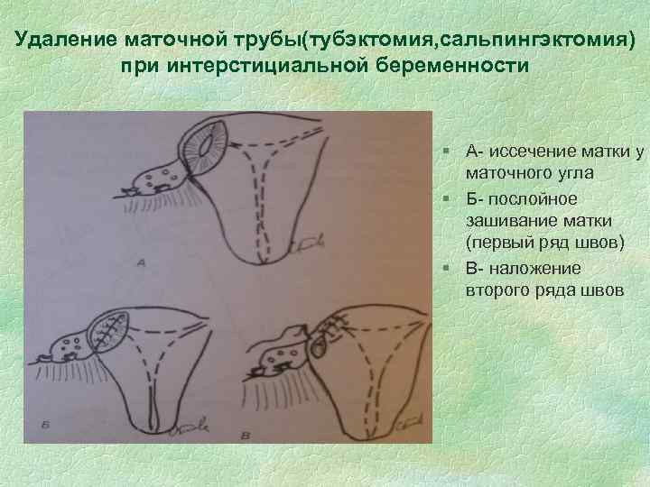 Удаление маточной трубы(тубэктомия, сальпингэктомия) при интерстициальной беременности § А- иссечение матки у маточного угла