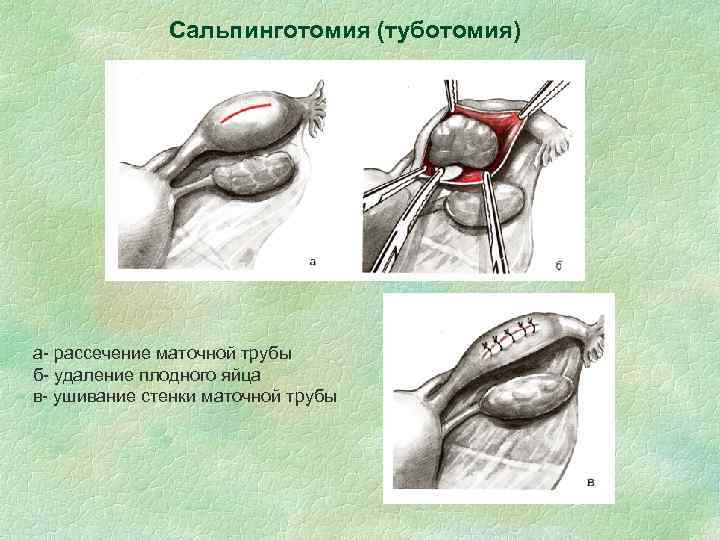 Сальпинготомия (туботомия) а- рассечение маточной трубы б- удаление плодного яйца в- ушивание стенки маточной