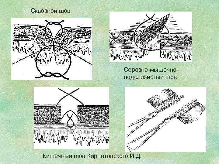 Сквозной шов Серозно-мышечноподслизистый шов Кишечный шов Кирпатовского И. Д. 
