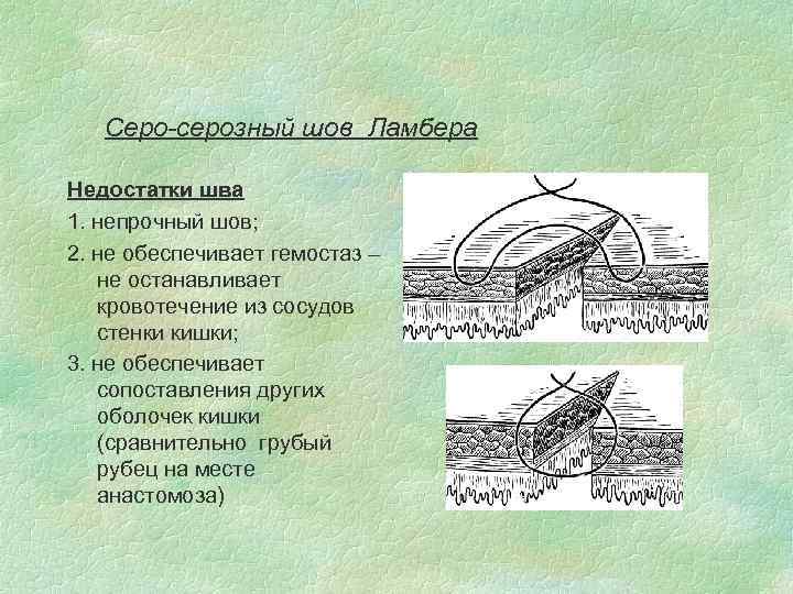 Серо-серозный шов Ламбера Недостатки шва 1. непрочный шов; 2. не обеспечивает гемостаз – не