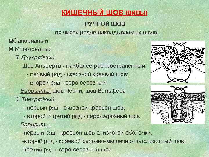 КИШЕЧНЫЙ ШОВ (ВИДЫ) РУЧНОЙ ШОВ по числу рядов накладываемых швов Однорядный Многорядный Двухрядный Шов