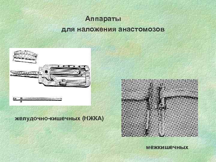 Аппараты для наложения анастомозов желудочно-кишечных (НЖКА) межкишечных 