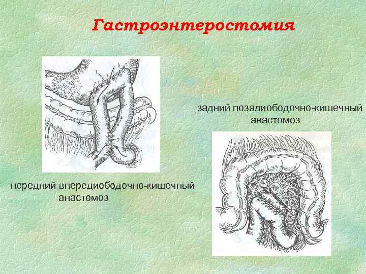 Гастроэнтеростомия задний позадиободочно-кишечный анастомоз передний впередиободочно-кишечный анастомоз 