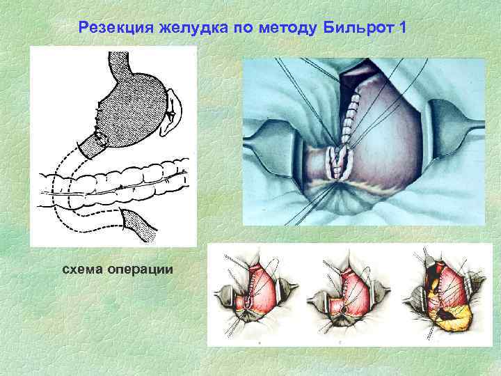 Резекция желудка по методу Бильрот 1 схема операции 