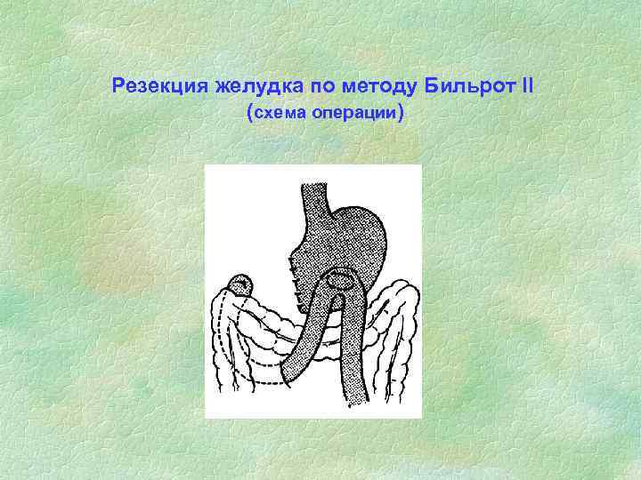 Резекция желудка по методу Бильрот II (схема операции) 