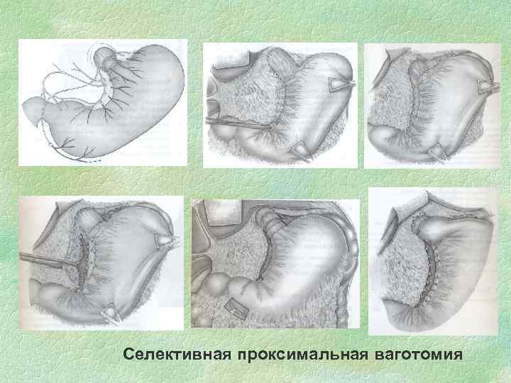 Селективная проксимальная ваготомия 