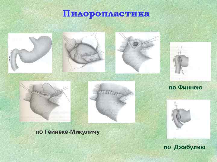 Пилоропластика по Финнею по Гейнеке-Микуличу по Джабулею 