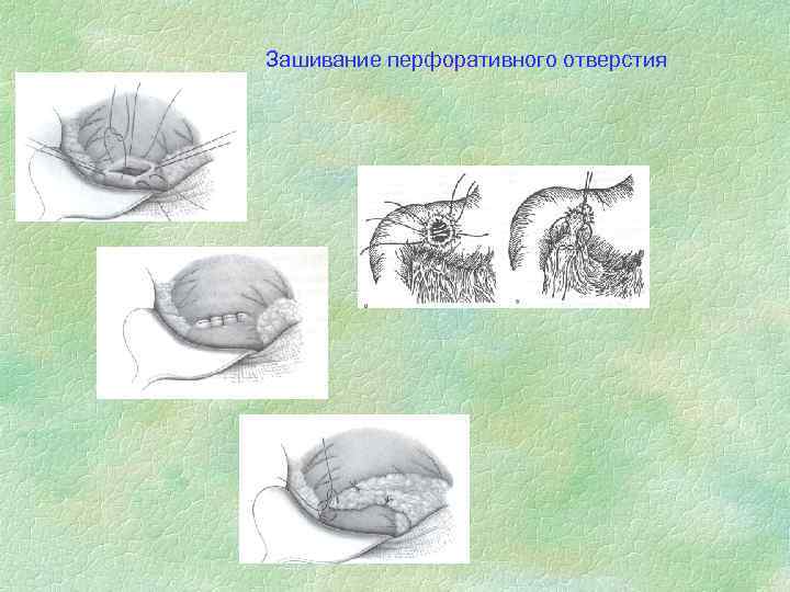 Зашивание перфоративного отверстия 