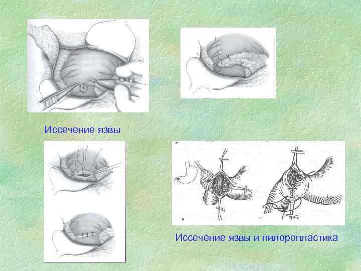 Иссечение язвы и пилоропластика 