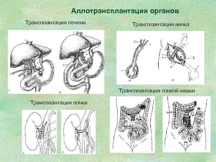 Аллотрансплантация органов Трансплантация печени Трансплантация яичка Трансплантация тонкой кишки Трансплантация почки 