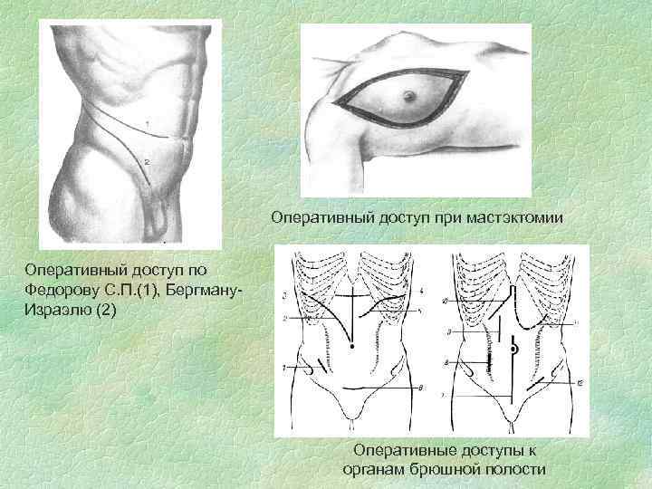 Оперативный доступ при мастэктомии Оперативный доступ по Федорову С. П. (1), Бергману. Израэлю (2)