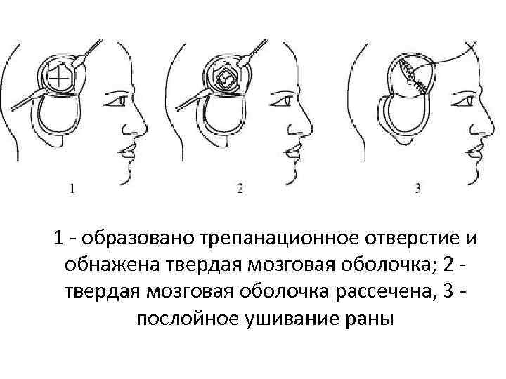 1 - образовано трепанационное отверстие и обнажена твердая мозговая оболочка; 2 - твердая мозговая