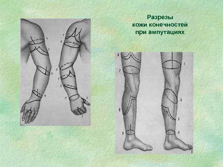 Разрезы кожи конечностей при ампутациях 