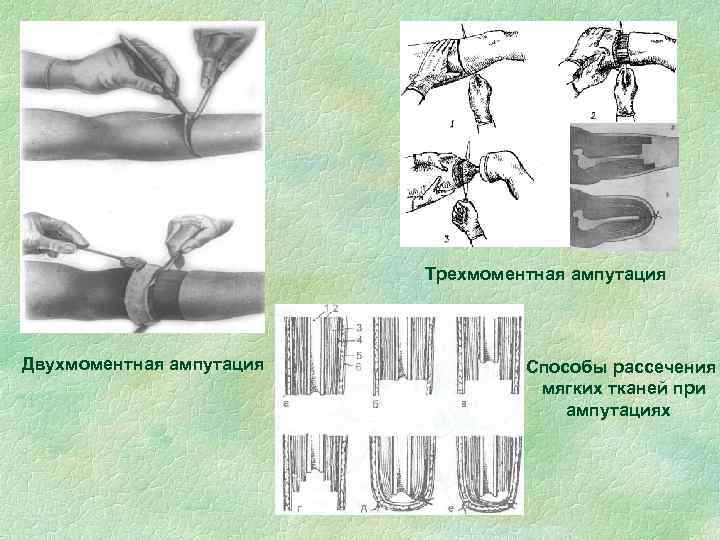 Трехмоментная ампутация Двухмоментная ампутация Способы рассечения мягких тканей при ампутациях 