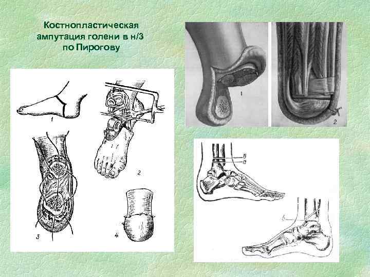 Костнопластическая ампутация голени в н/3 по Пирогову 