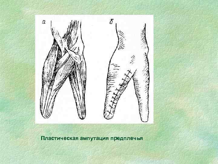 Пластическая ампутация предплечья 