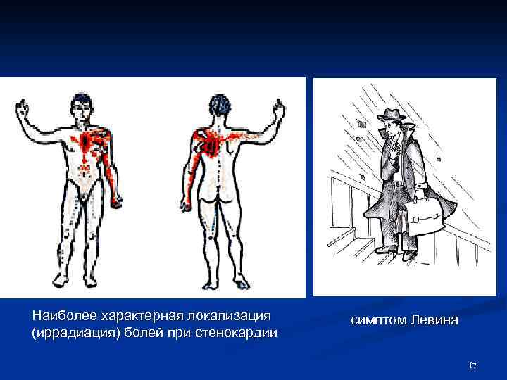 Наиболее характерная локализация (иррадиация) болей при стенокардии симптом Левина 17 