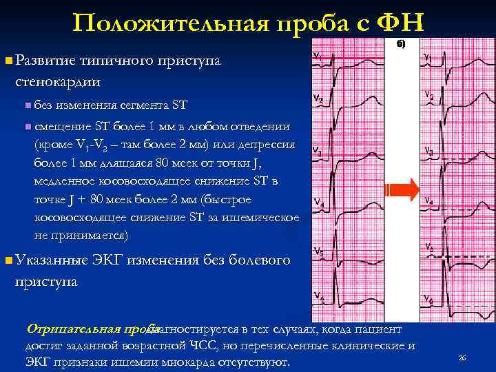 Положительная проба с ФН n Развитие типичного приступа стенокардии n без изменения сегмента ST