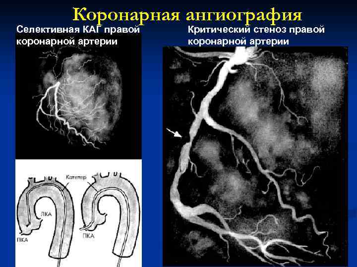 Коронарная ангиография Селективная КАГ правой коронарной артерии Критический стеноз правой коронарной артерии 28 