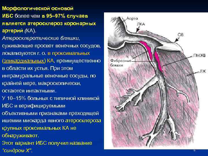 Морфологической основой ИБС более чем в 95– 97% случаев является атеросклероз коронарных артерий (КА).