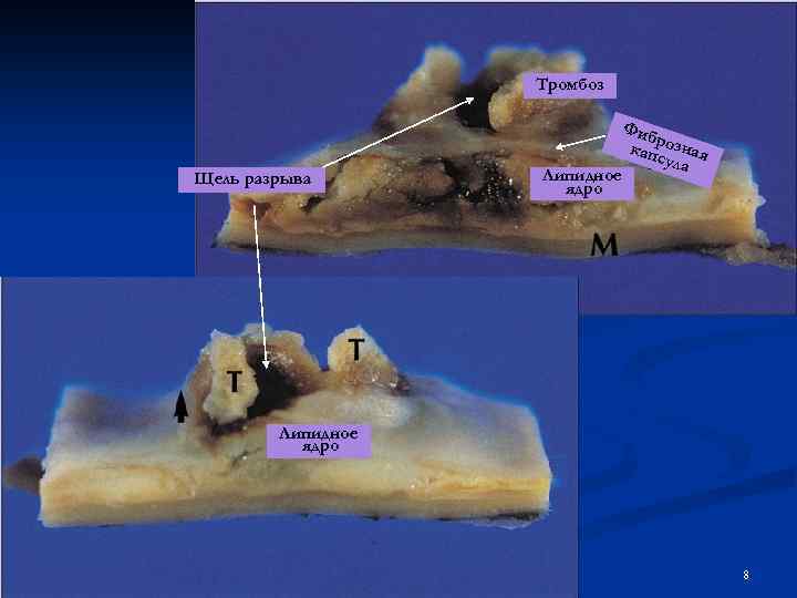 Тромбоз Щель разрыва Липидное ядро Фиб р кап озная сула Липидное ядро 8 