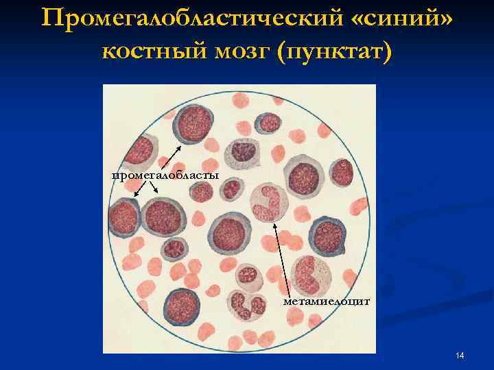 Промегалобластический «синий» костный мозг (пунктат) промегалобласты метамиелоцит 14 