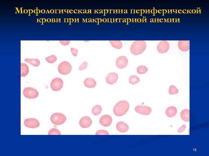 Пойкилоцитоз анемия. B12 дефицитная анемия картина крови. Фолиеводефицитная анемия картина. Картина крови фолиеводефицитной анемии. Картина крови при в12 дефицитной.