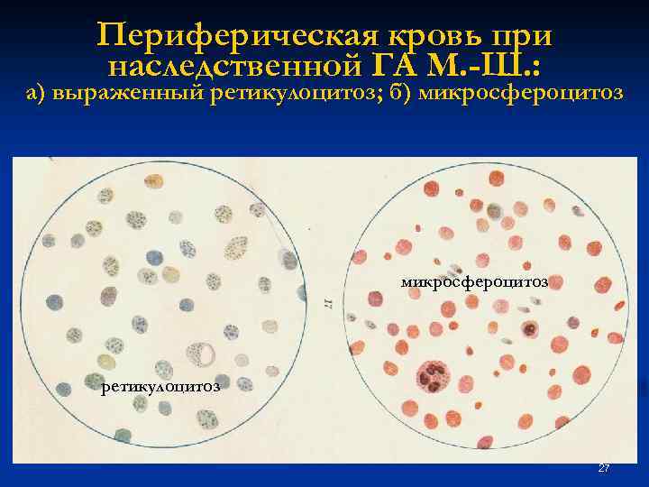 Периферическая кровь при наследственной ГА М. -Ш. : а) выраженный ретикулоцитоз; б) микросфероцитоз ретикулоцитоз