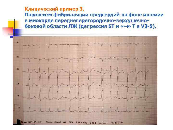 Клинический пример 3. Пароксизм фибрилляции предсердий на фоне ишемии в миокарде переднеперегородочно верхушечно боковой