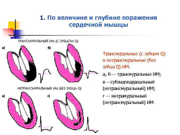 1. По величине и глубине поражения сердечной мышцы Трансмуральные (с зубцом Q) и нетрансмуральные