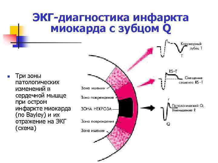 ЭКГ диагностика инфаркта миокарда с зубцом Q n Три зоны патологических изменений в сердечной
