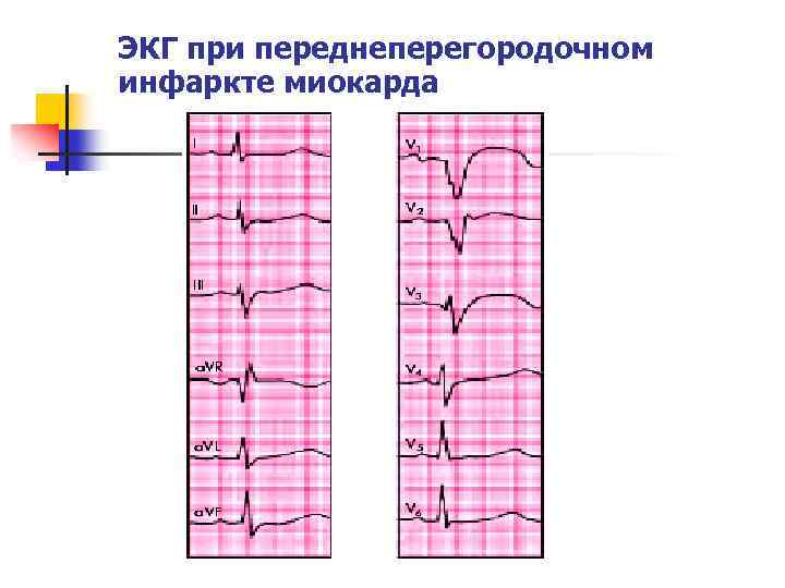 ЭКГ при переднеперегородочном инфаркте миокарда 