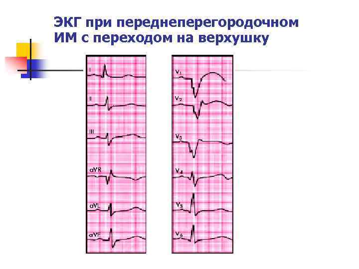 ЭКГ при переднеперегородочном ИМ с переходом на верхушку 