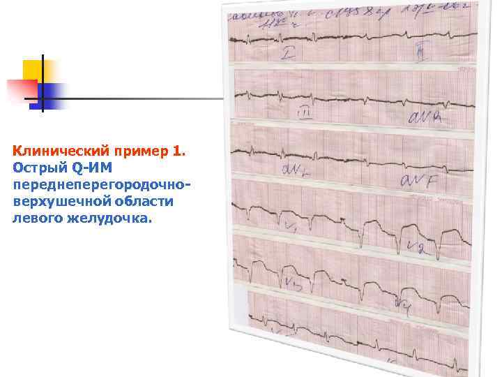 Клинический пример 1. Острый Q ИМ переднеперегородочно верхушечной области левого желудочка. 