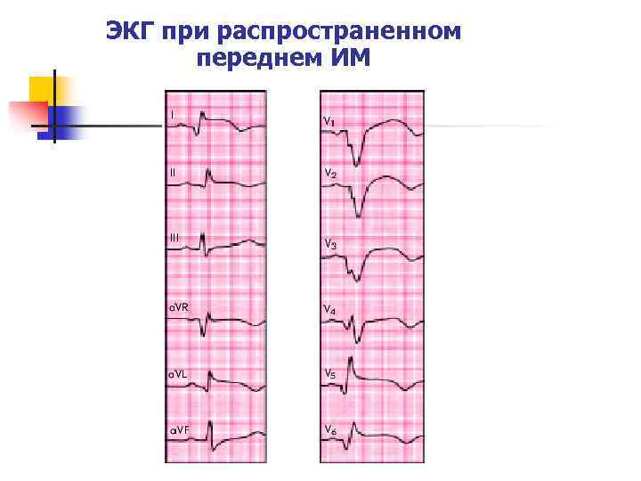 ЭКГ при распространенном переднем ИМ 