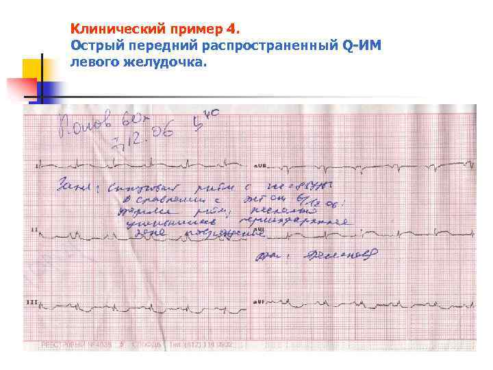 Клинический пример 4. Острый передний распространенный Q ИМ левого желудочка. 
