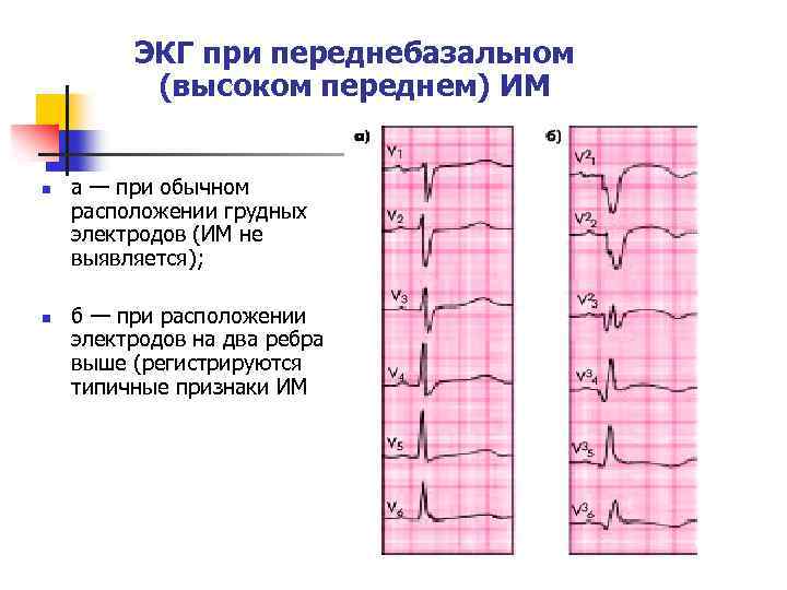 ЭКГ при переднебазальном (высоком переднем) ИМ n n а — при обычном расположении грудных