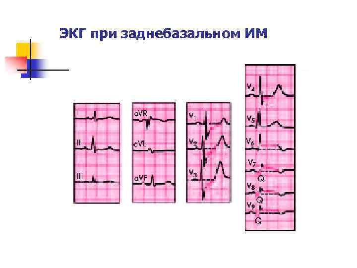 ЭКГ при заднебазальном ИМ 